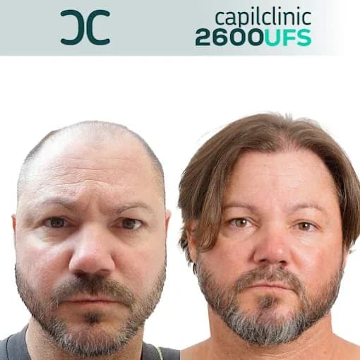 Antes - después de injerto capilar